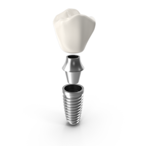 Dental Implant graphic